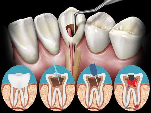 Danties pulpito gydymas