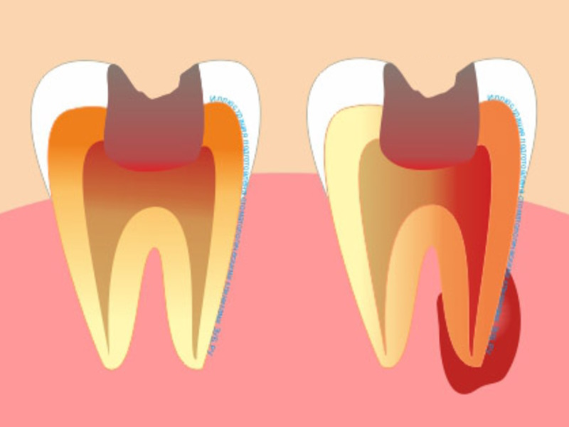 periodontitas